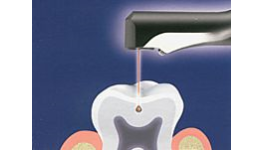 Ošetření zubů laserem - stomatologické ošetření laserovou technologií