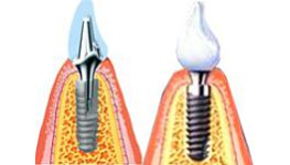 Kvalitní zubní implantáty, implantace, náhrada chybějících zubů