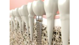Zubní implatáty-celková rekonstrukce chrupu i náhrada jednotlivých zubů