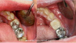 Zubní implantáty, výplně v barvě zubu-centrum estetické stomatologie