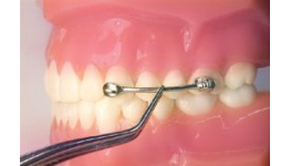 Korekce skusu - Carriere Motion Class II a III – e-shop pro ortodontické ordinace