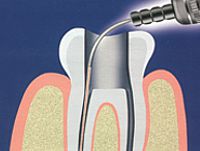 ošetření kořenového kanálku zubu laserem