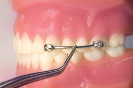 Korekce skusu - Carriere Motion Class II a III – e-shop pro ortodontické ordinace