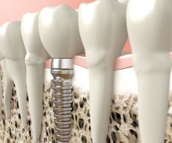 Implantologie, zavedení zubních titanových náhrad Brno