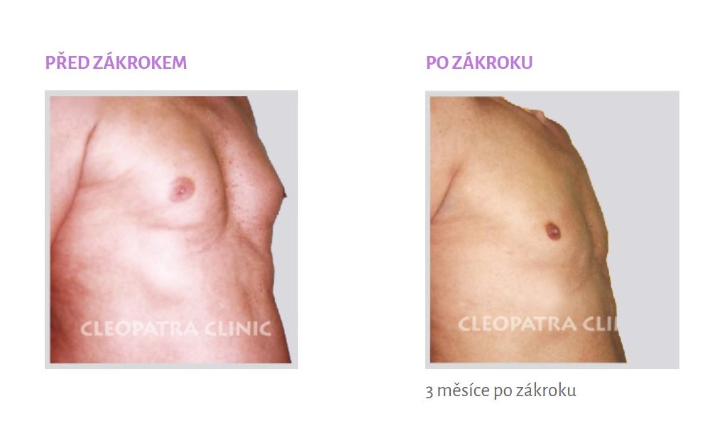 Gynekomastie - zmenšení - liposukcí + chirurgické odstranění žláz