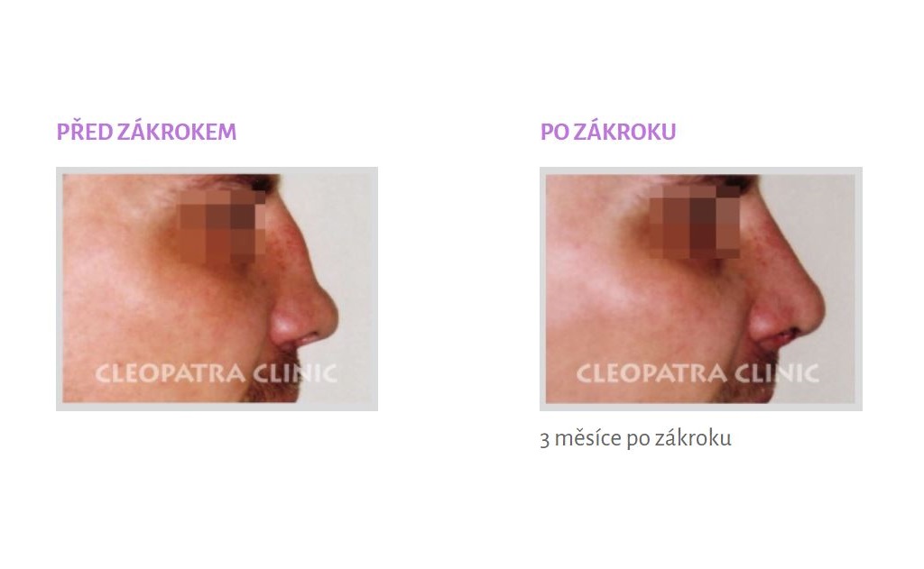 Plastické operace obličeje, nosu i očních víček Ostrava