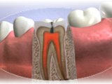 Endodoncie, léčba kořenových kanálků, Zlín, Otrokovice