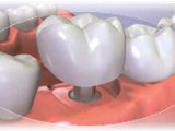 Zubní implantáty, CEREC korunky Zlín, Otrokovice