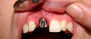 Zubní implantáty Praha 4