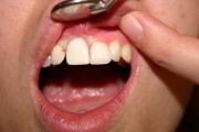 Zubní implantáty Praha 4