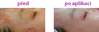 Laserové omlazení obličeje, pleti, pokožky, rejuvenace, laserová léčba akné