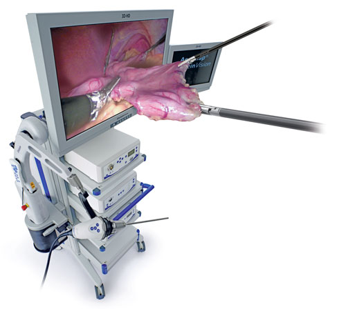 3D laparoskopie, laparoskopická operace