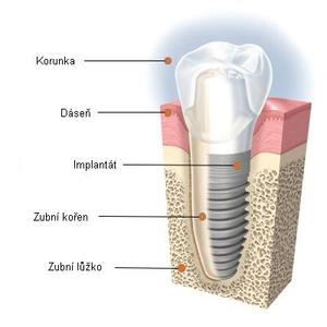 Implantologie - zubní náhrady Brno