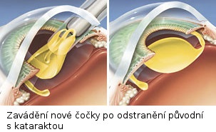 Včasná operace šedého zákalu zachrání váš zrak (Mladá Boleslav)