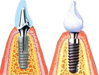 Zubné implantáty, implantácia zubov - dentálna klinika Rafael Zlín