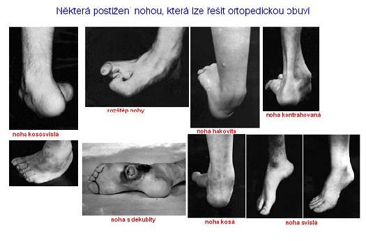 Některá postižení nohou lze řešit ortopedickou obuvi