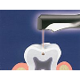 Ošetření zubů laserem - stomatologické ošetření laserovou technologií