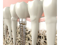 Implantologie – šetrná náhrada chybějících zubů titanovými implantáty