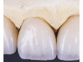 Protetika – zhotovení fixních nebo snímacích zubních náhrad
