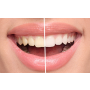 Bělení zubů nejmodernějšími technologiemi – Airflow, ordinační bělení