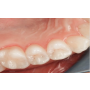 Ošetření zubních defektů bezbolestnou estetickou stomatologií – aplikace tzv. Bílých plomb