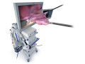 3D laparoskopie, laparoskopická operace
