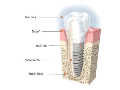 Implantologie - zubní náhrady Brno
