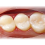 Estetické, bílé zubní výplně, plomby, ordinační bělení zubů