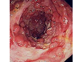 Crohnova choroba - riziko rakoviny tlustého střeva