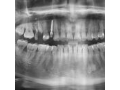 Zubní implantáty Timplant a Nanoimplant Ostrava