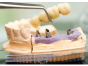 implantologie Praha 4 - zubní implantáty pro plnohodnotný život od značky Straumann a Camlog