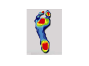 Počítačová analýza chůze - důležité vyšetření při řešení bolesti chodidel