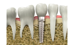 Zubní implantáty pro úplný chrup