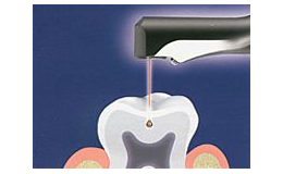 léčba zubního kazu laserem - bez vrtání a bolesti