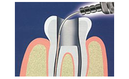 ošetření kořenového kanálku zubu laserem