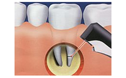 využití laseru v zubní chirurgii
