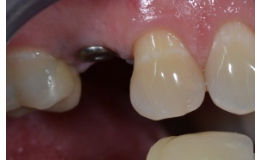 Zubní protetika