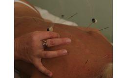Akupunktura Praha - čínská léčba