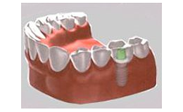 náhrada jednoho zubu implantátem