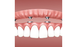 Zubní implantáty