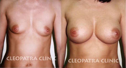 Zvětšení ženských prsou pomocí kvalitních implantátů