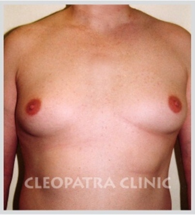 Plastické operace zvětšených mužských prsou