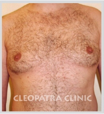 Plastická operace prsou u mužů - po zákroku
