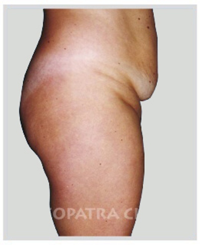 Plastická operace břicha - odstranění tuků a kůže