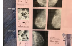 Mamologie, mamografické vyšetření, prevence nádoru prsu