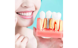 Zubní implantáty přirozeného vzhledu